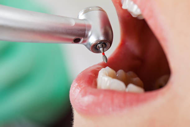 Best Emergency Tooth Extraction in Wheaton, MN